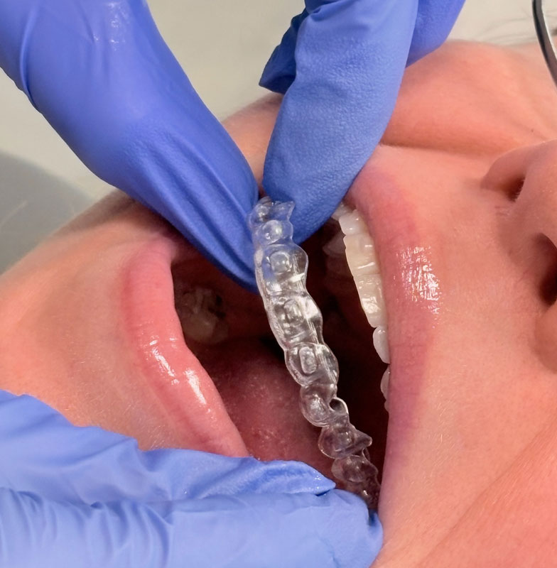 Considerations with clear aligners