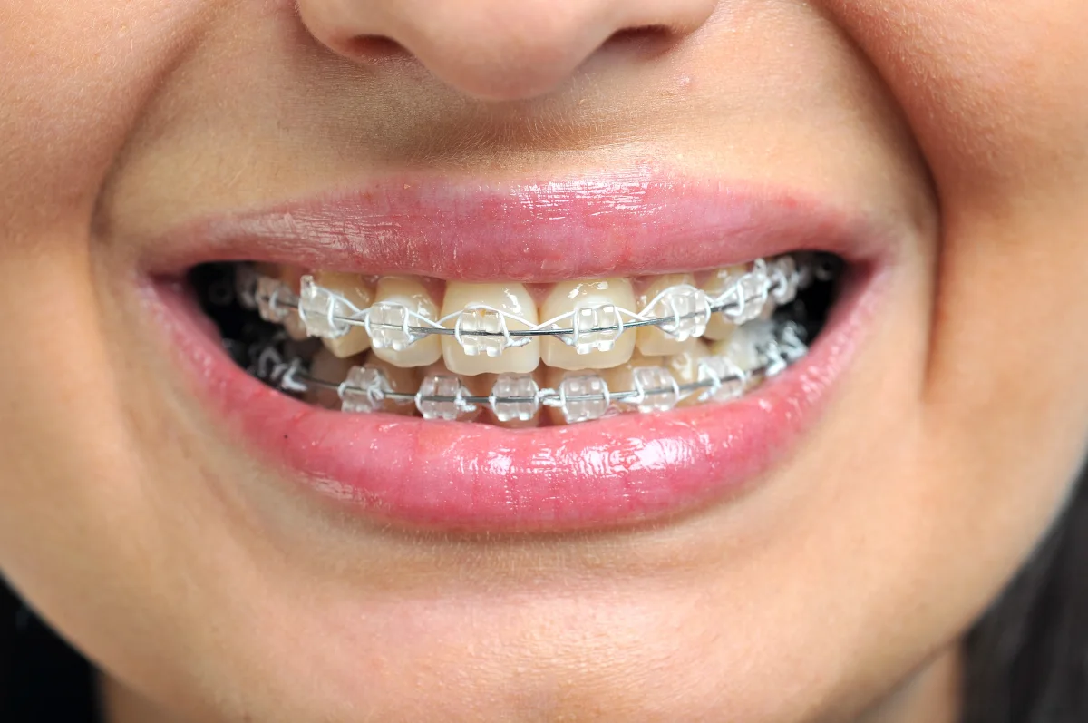 Is it worth getting braces as an adult? A confident adult smiling after orthodontic treatment at Profile Orthodontics in Perth